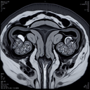 МРТ гістеросальпінгографія прохідності маточних труб