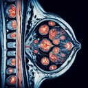 МРТ мамографія молочних залоз грудей